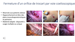 session2-cours 12 - prevention trocarts