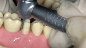 PCP 25 reduction proximales