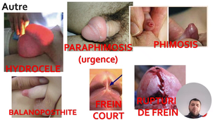 ITEM 50 AUTRES PATHOLOGIES SCROTALES